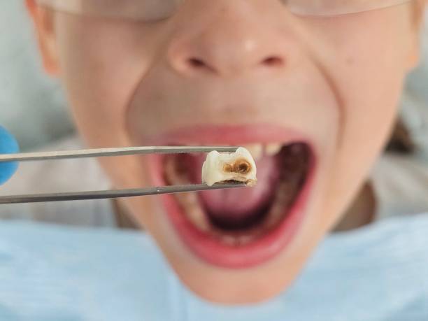 Best Emergency Treatment for Toothache in Ogdensburg, NY