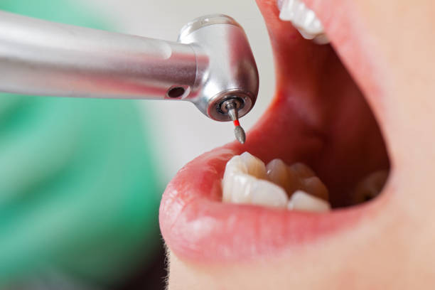 Best Emergency Broken Tooth Repair in Ogdensburg, NY